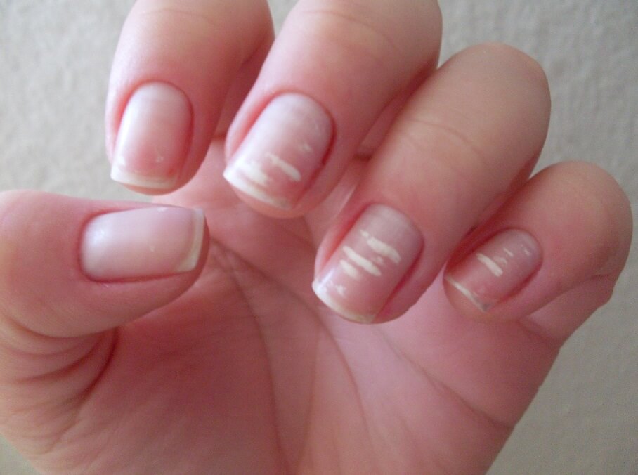 Como evitar y tratar las manchas blancas en las uñas-